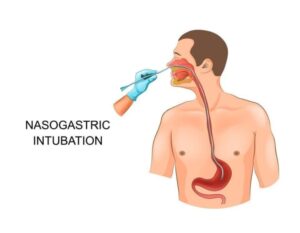 Đặt Sonde dạ dày tại nhà