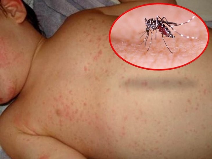 xét nghiệm sốt xuất huyết tại nhà