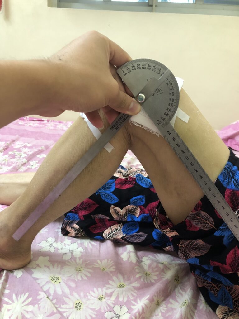 phục hồi chức năng sau thay khớp gối