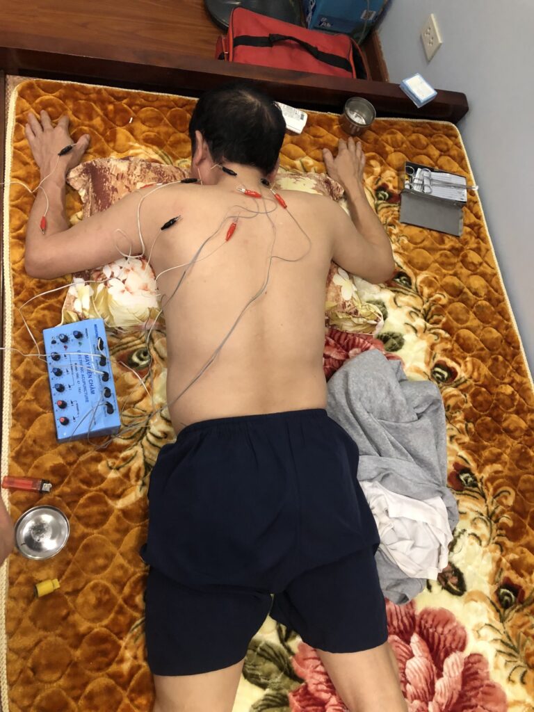 Châm cứu tại nhà Hà Nội